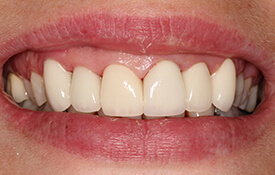 Perfect smile following dental care