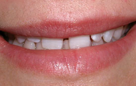 Closeup of smile with large gap between front teeth