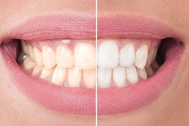Closeup of smile half before half after teeth whitening