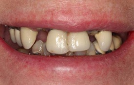Before Teeth in a Day Treatment