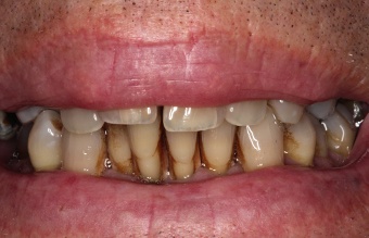 Before image before dental implant hybrid dentures