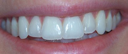 Closeup of flawless smile after Invisalign