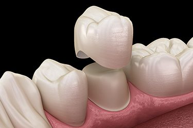 Illustration of dental crown being placed on tooth