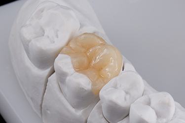 Ceramic onlay on dental model