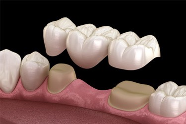 Illustration of traditional dental bridge being placed on teeth