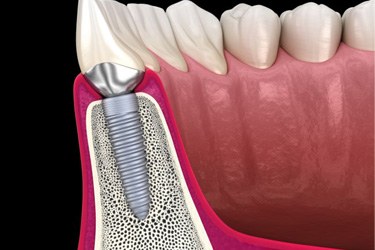 Side view of dental implant in jawbone