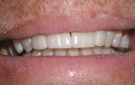 Chipped front tooth flawlessly repaired