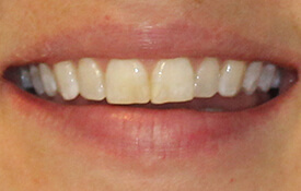 Closeup of discolored front teeth