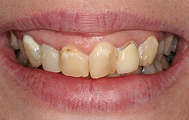 Severely decayed and discolored teeth