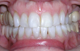 Smile following orthodontic treatment