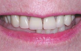 Large gap between front teeth
