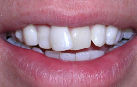 Bright white healthy smile