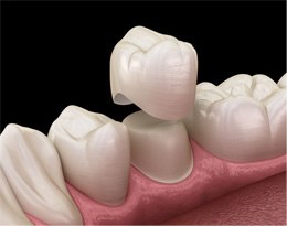 Illustration of dental crown being placed on tooth