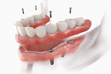 Illustration of implant dentures for lower arch