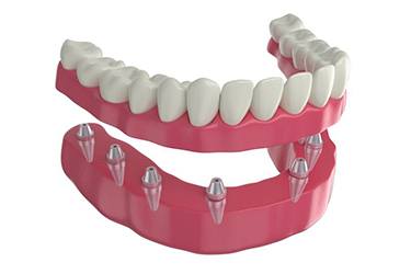 Simple illustration of implant dentures against white background