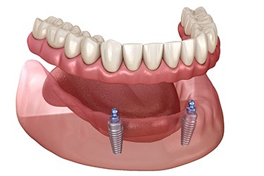 Illustration of denture stabilized by two dental implants