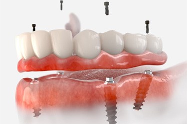 Illustration showing implant dentures for lower dental arch
