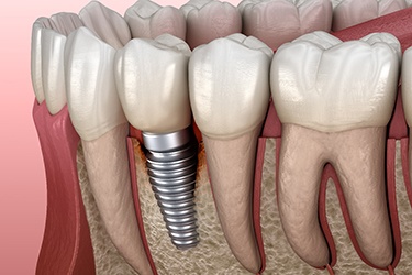 Illustration of peri-implantitis, a common cause of dental implant failure