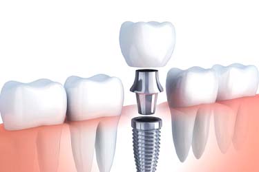 Digital Illustration of dental implants in Schenectady