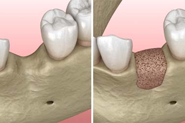 Before and after bone grafting for dental implants in Schenectady