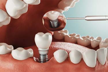 Digital illustration of dental implants in Schenectady