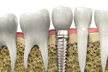 Dental implant in Schenectady during osteointegration