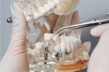Schenectady implant dentist holding model jaw with dental implants