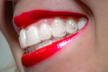 Close-up of beautiful smile with red lips wearing clear aligner