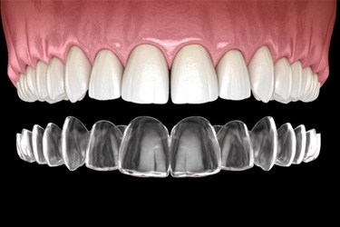 Illustration of clear aligner being placed on teeth in upper arch