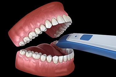 Illustration of digital scanning process for treatment planning