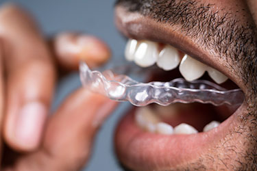 Close up of Man putting Invisalign in mouth