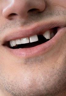Man showing missing tooth