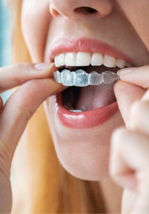 Woman placing aligners on teeth