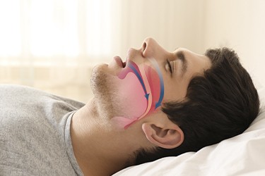 What Causes Sleep Apnea?