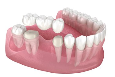 Illustration of dental bridge being placed on lower dental arch