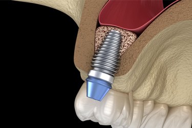 Illustration of implant in upper jaw following sinus lift