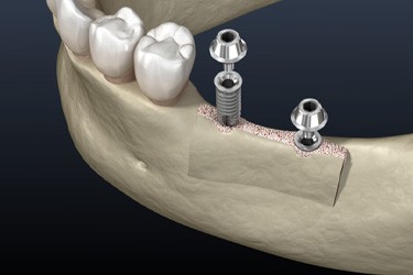 Implants being placed in jawbone after ridge augmentation surgery