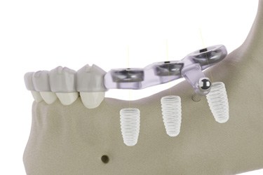 Side-view illustration of surgical guide for dental implants
