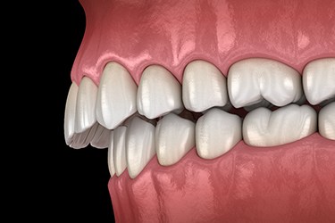 Illustration of a deep overbite against black background