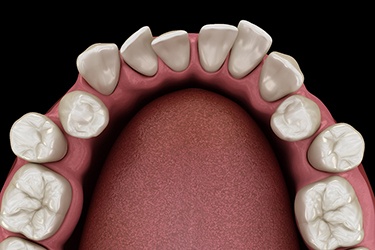 Illustration of crooked teeth that Invisalign can fix