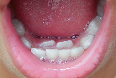 Photo of a child with baby and permanent teeth overlapping