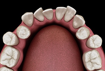 Illustration of a crowded teeth against black background