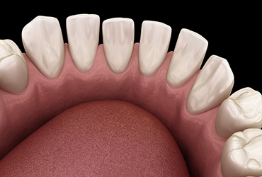 Illustration of a gapped teeth