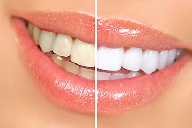 Close-up of patient’s teeth before and after whitening treatment