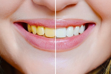 Woman’s smile before and after whitening