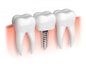 illustration of dental implant