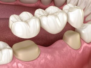 Close-up illustration of three-unit dental bridge