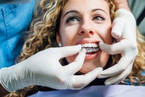 Dentist helping patient place Invisalign in her mouth