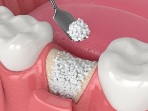 Illustration of bone graft being placed in tooth socket