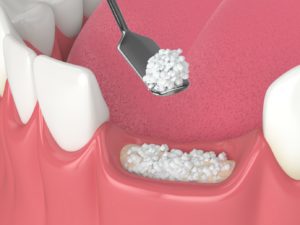  Illustration of bone granules being used during dental bone graft